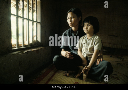 Le sorelle Lien, 8 anni, e Hien, 6 anni, sono nate dopo che il loro padre è stato spruzzato durante la guerra del Vietnam con l'agente Orange dagli aerei degli Stati Uniti. Né hanno lenti nei loro occhi. Foto Stock