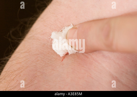 Sfera di cotone mettendo sotto pressione la ferita di perforazione sono state un ago è stato inserito in vena per un campione di sangue. Foto Stock