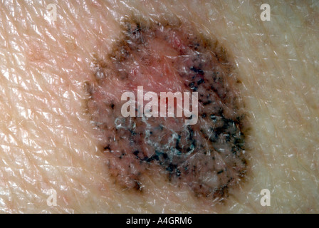 Una fotografia di un carcinoma delle cellule basali. Foto Stock