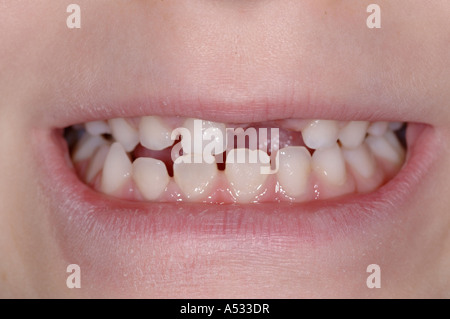 Smile con recentemente mancante dente anteriore Foto Stock