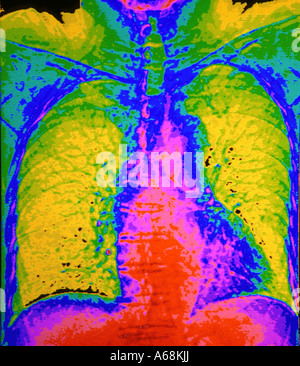 Scansione TC del torace e del polmone Foto Stock