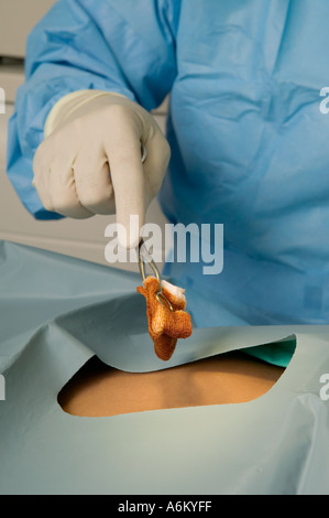 Preparazione della pelle con betadine soluzione un antseptic durante la chirurgia Foto Stock