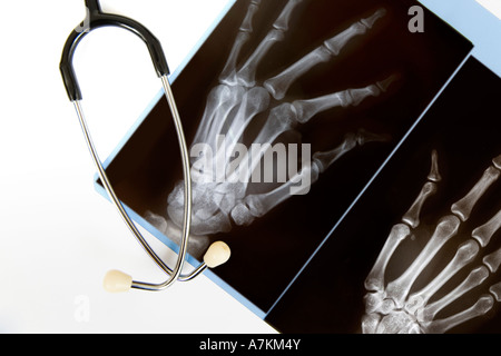 A raggi x di una mano con uno stetoscopio isolato su bianco Foto Stock