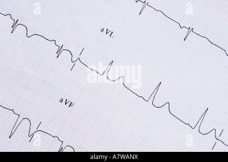 Un tracciato ECG che mostra post attacco di cuore i risultati Foto Stock