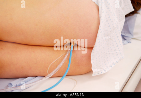Donna con enema del bario sulla tavola di Siemens Medical Solutions Axiom Iconos R200 fluoroscopia l'unità di imaging ospedale privato REGNO UNITO Foto Stock