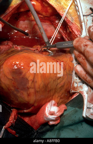 Bypass coronarico CABG Foto Stock