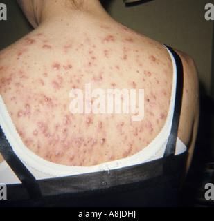 Cystica acne sulla schiena del paziente. Foto Stock
