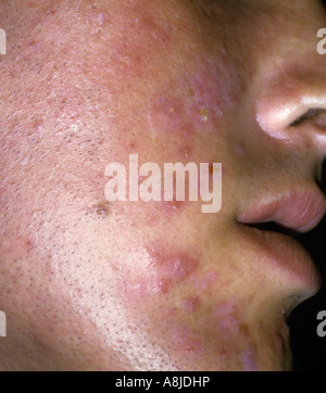 Acne sul giovane viso del paziente. Foto Stock