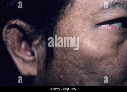 Acne vulgaris sul viso del paziente. Seborrea oleosa gravi. Foto Stock