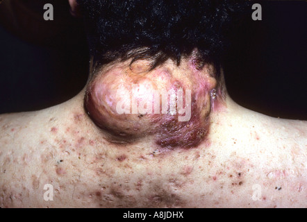Acne vulgaris sulla schiena del paziente. Seborrea oleosa gravi. Foto Stock