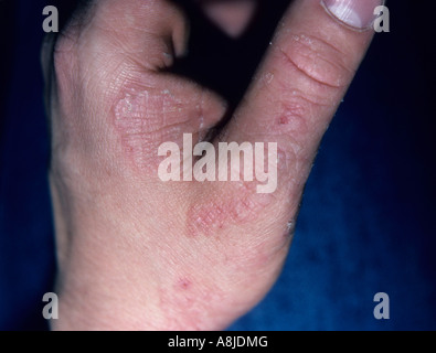 Infezione da fungo chiamato Tinea manus sulla mano. Noto anche come tigna della mano. Foto Stock