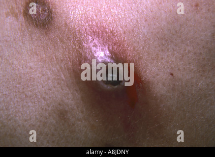 Paziente con la dolorosa herpes zoster varicella rash. Noto anche come herpes zoster virus del vaiolo. Foto Stock