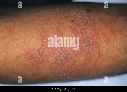 Nummular eczema sul braccio del paziente. Dermatiti eczematose. Foto Stock