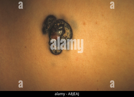 Nodulari melanoma maligno Cancro Foto Stock