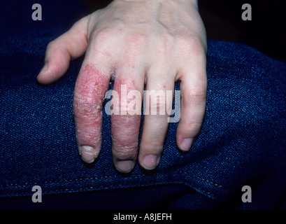 La mano e le dita con nummular eczema Foto Stock