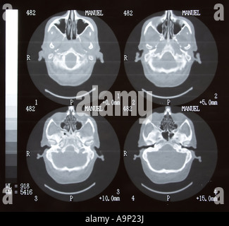 Tomografia cerebrale Foto Stock