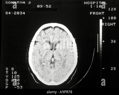 CT scan cervello normale e il cranio Foto Stock