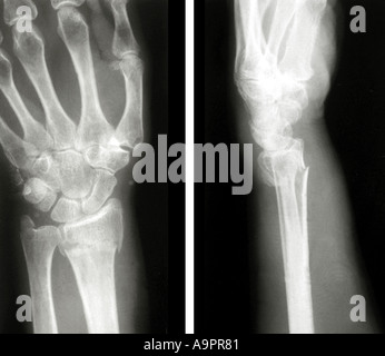 X ray frattura di Colles Foto Stock