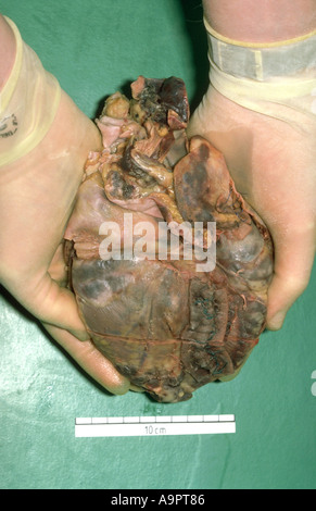 Cuore modello di infarto miocardico Foto Stock