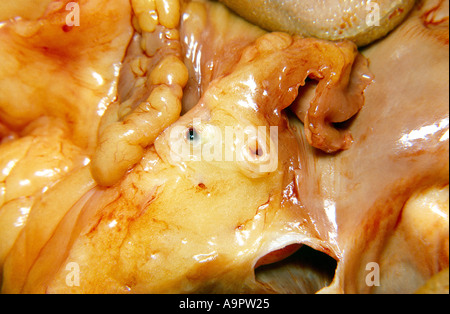 Cuore modello di infarto miocardico Foto Stock