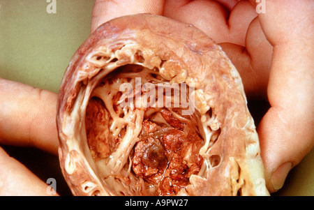 Cuore modello di infarto miocardico Foto Stock