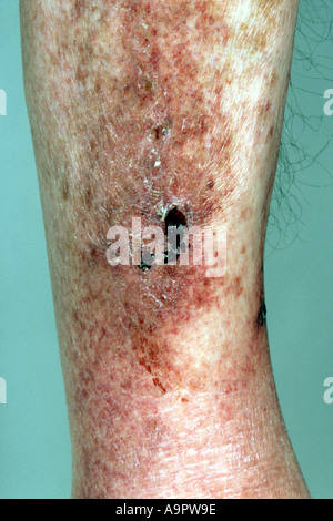 Eruzione cutanea scorbuto Foto Stock
