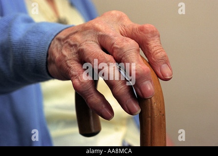 Artrite, una signora anziana con artrite severa, 'artrite reumatoide' Foto Stock