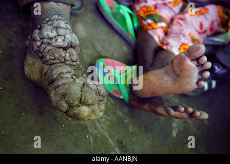 Un uomo con Podoconiosi infiammatorio cronico nei suoi piedi. Provincia del Nord Kivu Repubblica Democratica del Congo Africa Foto Stock