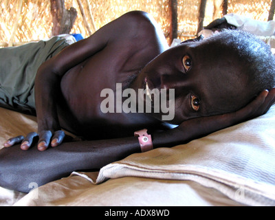 La Leishmaniosi Kala Azar o noto anche come febbre nero Foto Stock