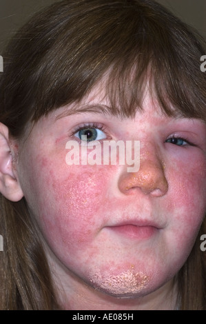 Ragazza giovane con poison ivy rash sul suo viso che lei sta trattando con calamina lozione Foto Stock