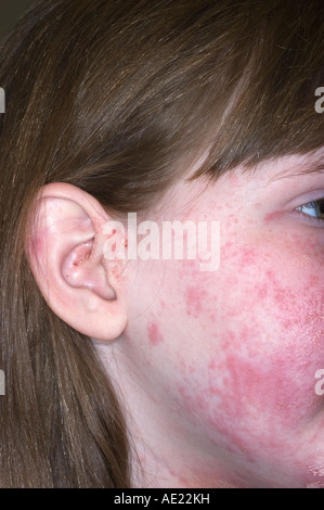 Ragazza giovane con poison ivy rash sul suo viso che lei sta trattando con calamina lozione Foto Stock