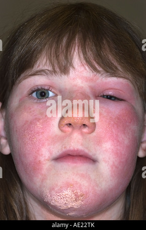 Ragazza giovane con poison ivy rash sul suo viso che lei sta trattando con calamina lozione Foto Stock