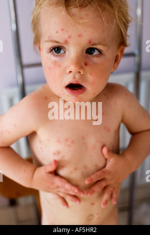 Ragazzo con la varicella Foto Stock