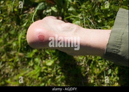 Un blister sul tallone di un alpinista dal male gli stivali di montaggio Foto Stock