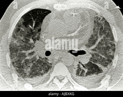 Una scansione CT di acuta o sindrome da distress respiratorio dell'adulto (ARDS) Foto Stock