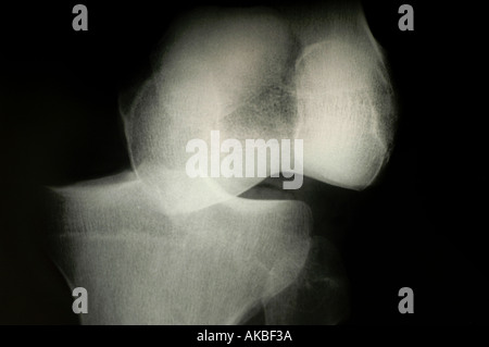 X-ray, la dislocazione ossea dopo incidente Foto Stock