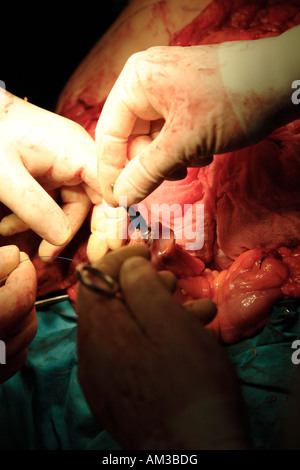 Cucitrice di chiusura e cucitura intestino durante l'operazione per rimuovere il cancro al colon Foto Stock