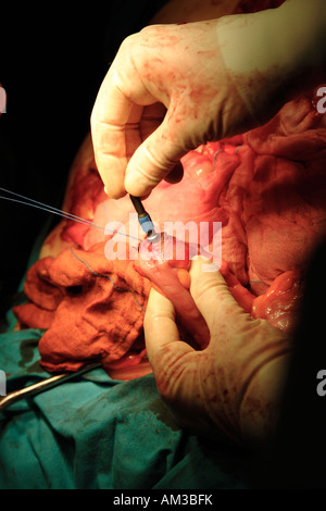 Cucitrice di chiusura e cucitura intestino durante l'operazione per rimuovere il cancro al colon Foto Stock