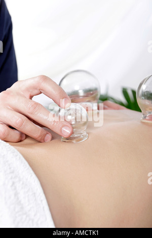 Donna di ricezione di agopuntura cupping metà sezione Foto Stock