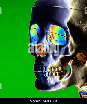 Raggi x del cranio umano con codice colore Foto Stock