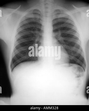 Petto x ray Hodgkins dopo la radioterapia Foto Stock