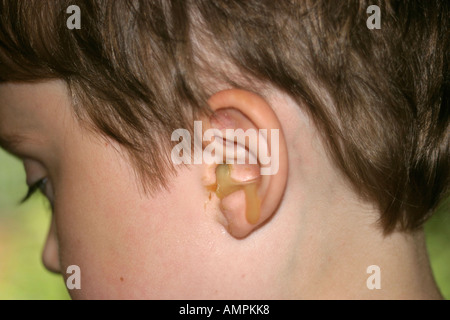Otite media orecchio sinistro lo scarico sembra molto inquietante Foto Stock