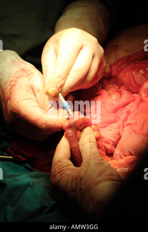 Cucitrice di chiusura e cucitura intestino durante l'operazione per rimuovere il tumore all'intestino Foto Stock