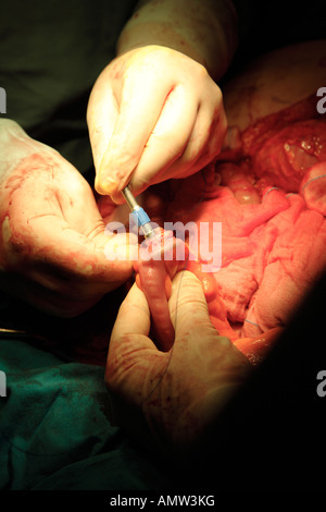 Cucitrice di chiusura e cucitura intestino durante l'operazione per rimuovere il tumore all'intestino Foto Stock