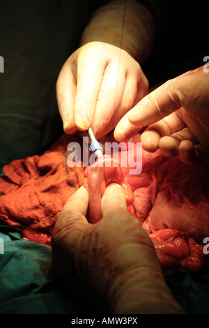 Cucitrice di chiusura e cucitura intestino durante l'operazione per rimuovere il tumore all'intestino Foto Stock