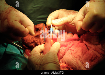 Cucitrice di chiusura e cucitura intestino durante l'operazione per rimuovere il tumore all'intestino Foto Stock