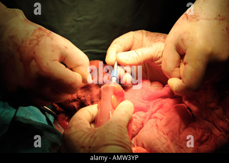 Cucitrice di chiusura e cucitura intestino durante l'operazione per rimuovere il tumore all'intestino Foto Stock