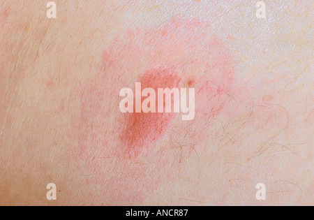 Target di eruzioni da Deer Tick Bite trasmettendo Lyme malattia s Foto Stock