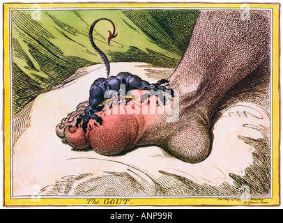 La gotta James Gillray 1799 cartoon dal grande caricaturista dell agonia indotta dalla malattia infiammatoria Foto Stock