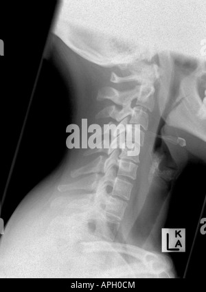 Laterali di raggi X di una colonna vertebrale cervicale (del collo), che mostra lo spasmo, ma nessuna frattura, cioè una distorsione solo Foto Stock